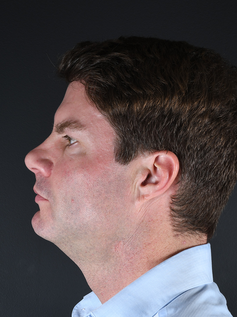 Neck Liposuction Before and After | Northside Plastic Surgery