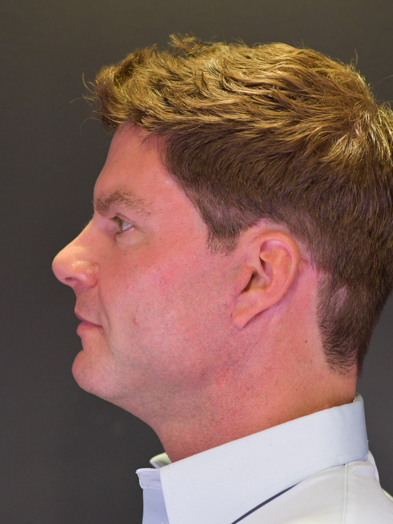 Neck Liposuction Before and After | Northside Plastic Surgery