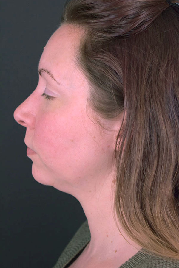 Neck Liposuction Before and After | Northside Plastic Surgery