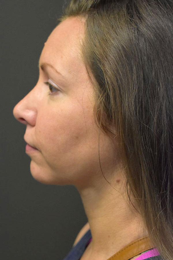 Neck Liposuction Before and After | Northside Plastic Surgery