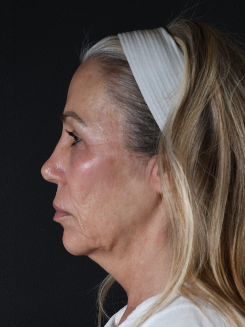 Neck Liposuction Before and After | Northside Plastic Surgery
