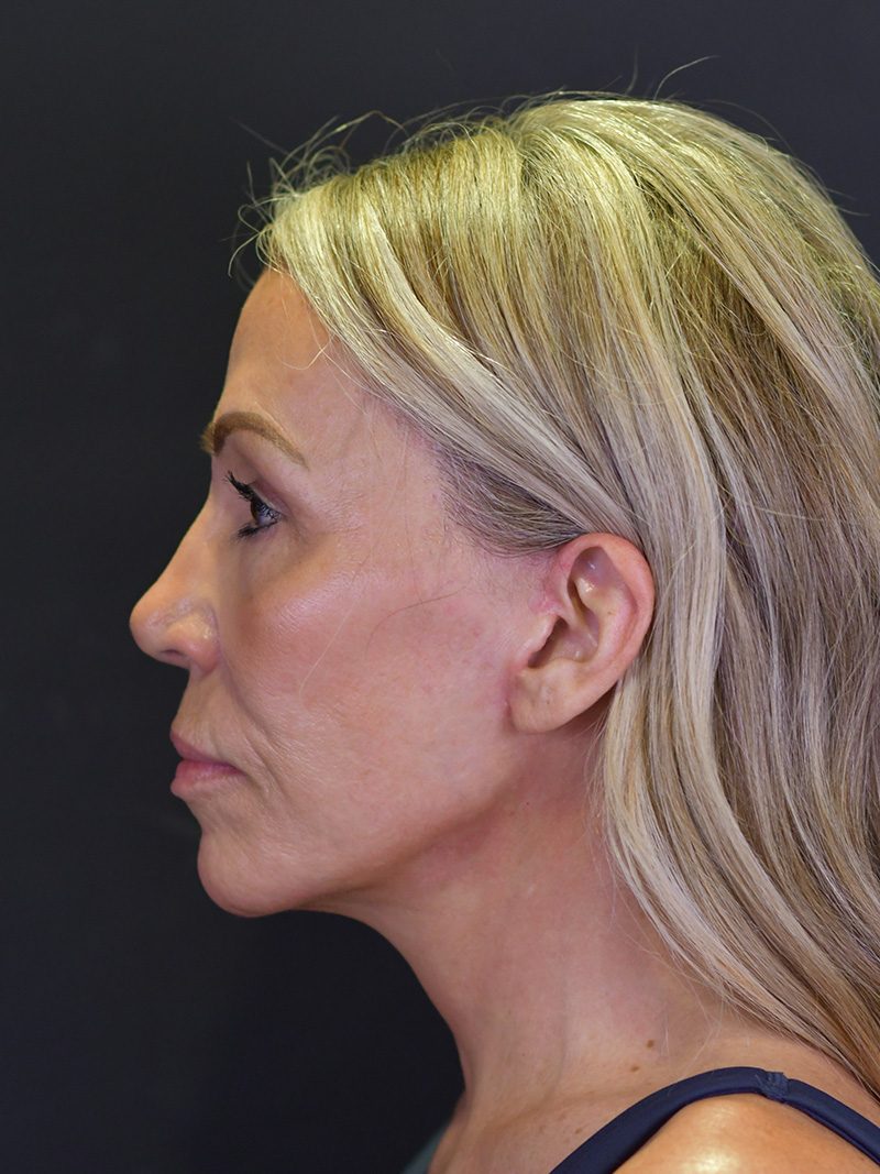 Neck Liposuction Before and After | Northside Plastic Surgery