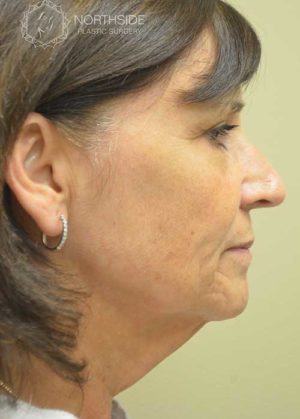 Neck Liposuction Before and After | Northside Plastic Surgery