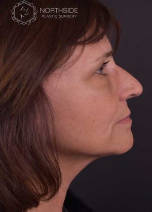 Neck Liposuction Before and After | Northside Plastic Surgery