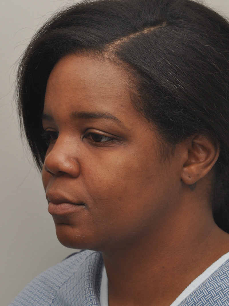 Neck Liposuction Before and After | Northside Plastic Surgery