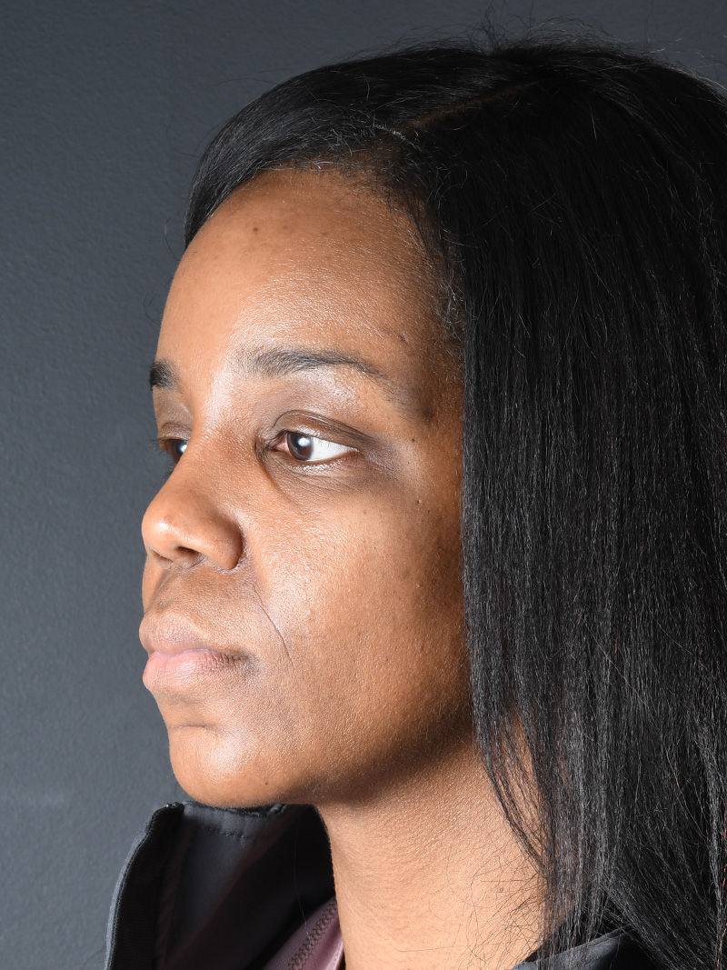 Neck Liposuction Before and After | Northside Plastic Surgery