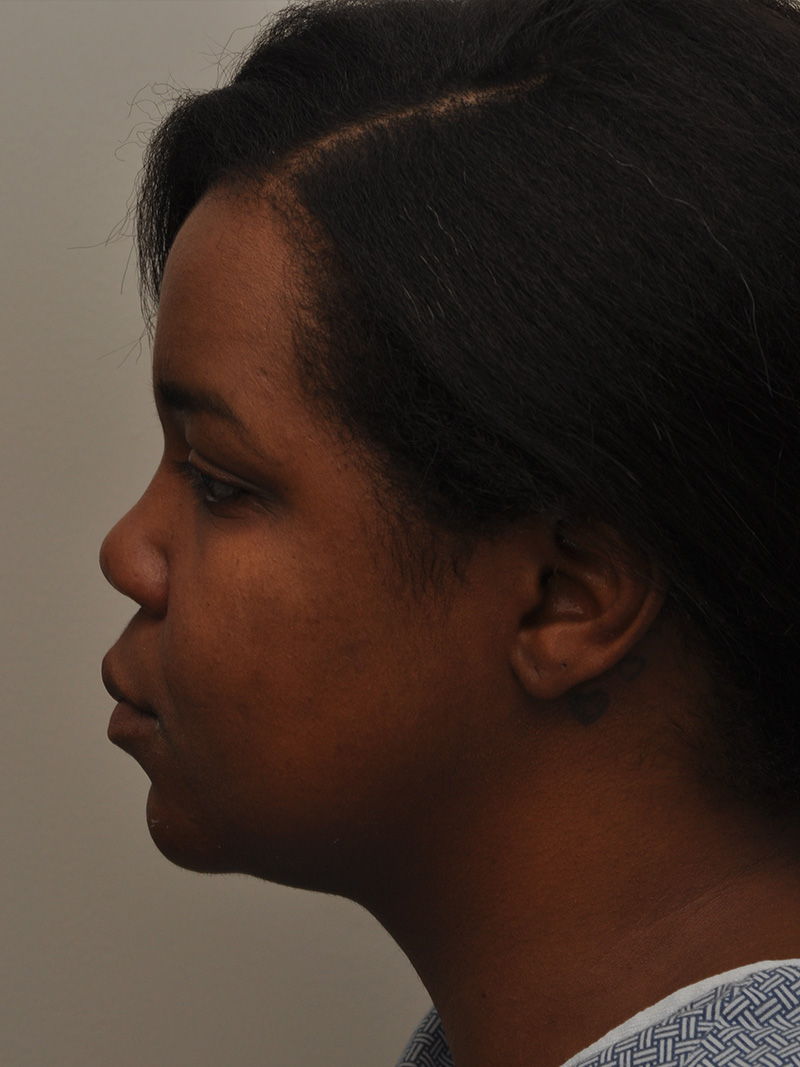 Neck Liposuction Before and After | Northside Plastic Surgery