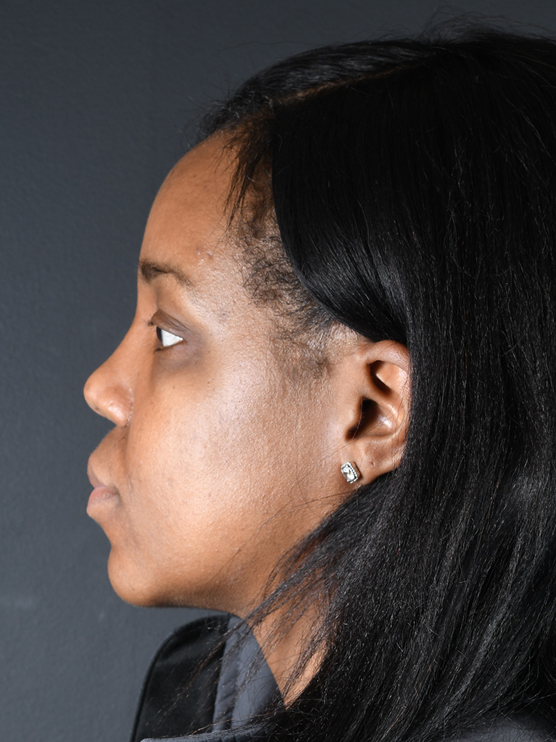 Neck Liposuction Before and After | Northside Plastic Surgery