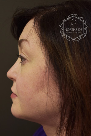 Neck Liposuction Before and After | Northside Plastic Surgery