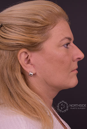 Neck Liposuction Before and After | Northside Plastic Surgery