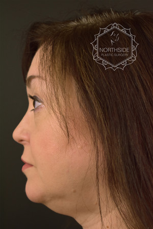 Neck Liposuction Before and After | Northside Plastic Surgery