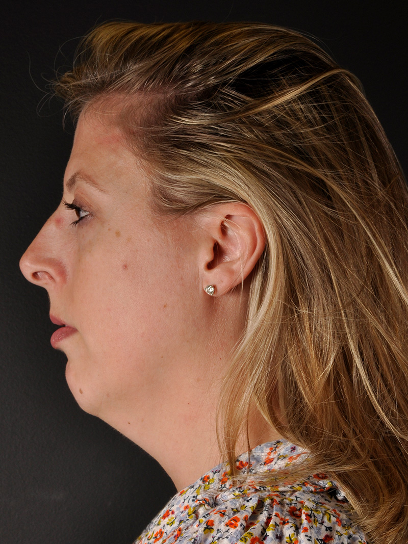 Neck Liposuction Before and After | Northside Plastic Surgery