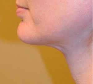 Neck Liposuction Before and After | Northside Plastic Surgery