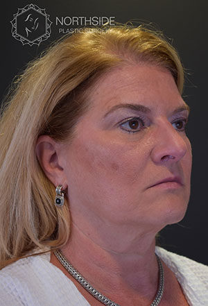 Neck Liposuction Before and After | Northside Plastic Surgery