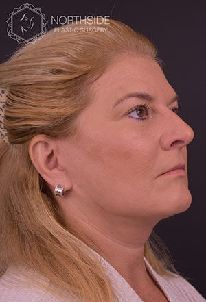 Neck Liposuction Before and After | Northside Plastic Surgery