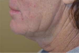 Neck Liposuction Before and After | Northside Plastic Surgery