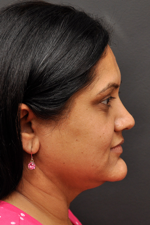 Neck Liposuction Before and After | Northside Plastic Surgery