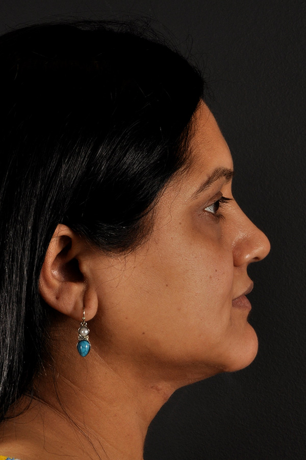Neck Liposuction Before and After | Northside Plastic Surgery