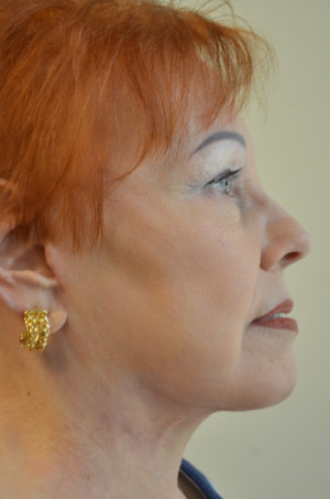 Neck Liposuction Before and After | Northside Plastic Surgery