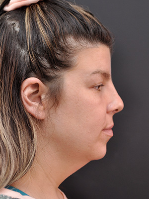 Neck Liposuction Before and After | Northside Plastic Surgery