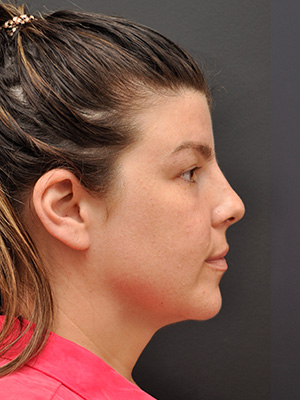 Neck Liposuction Before and After | Northside Plastic Surgery