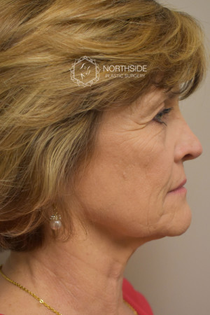 Neck Liposuction Before and After | Northside Plastic Surgery