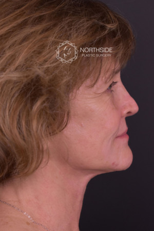 Neck Liposuction Before and After | Northside Plastic Surgery