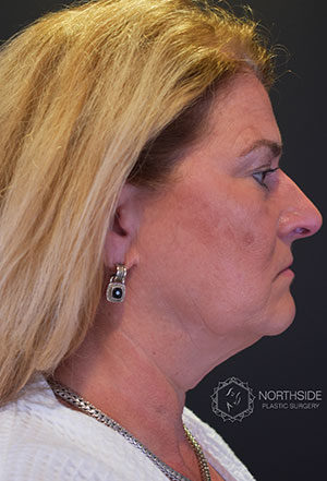 Neck Liposuction Before and After | Northside Plastic Surgery