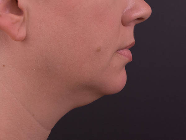 Neck Liposuction Before and After | Northside Plastic Surgery