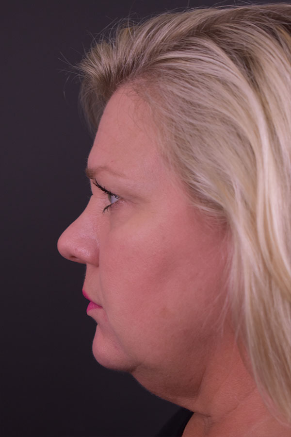 Neck Liposuction Before and After | Northside Plastic Surgery