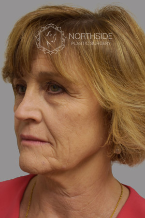 Neck Liposuction Before and After | Northside Plastic Surgery