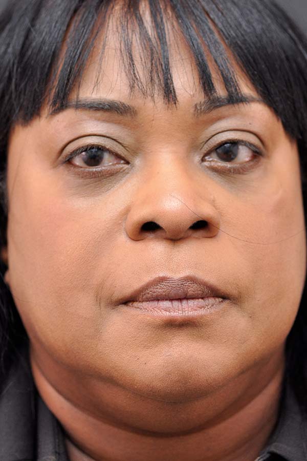 Neck Liposuction Before and After | Northside Plastic Surgery