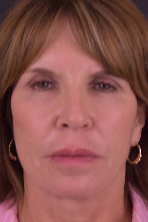 Neck Liposuction Before and After | Northside Plastic Surgery