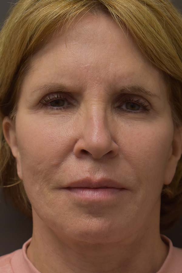 Neck Liposuction Before and After | Northside Plastic Surgery