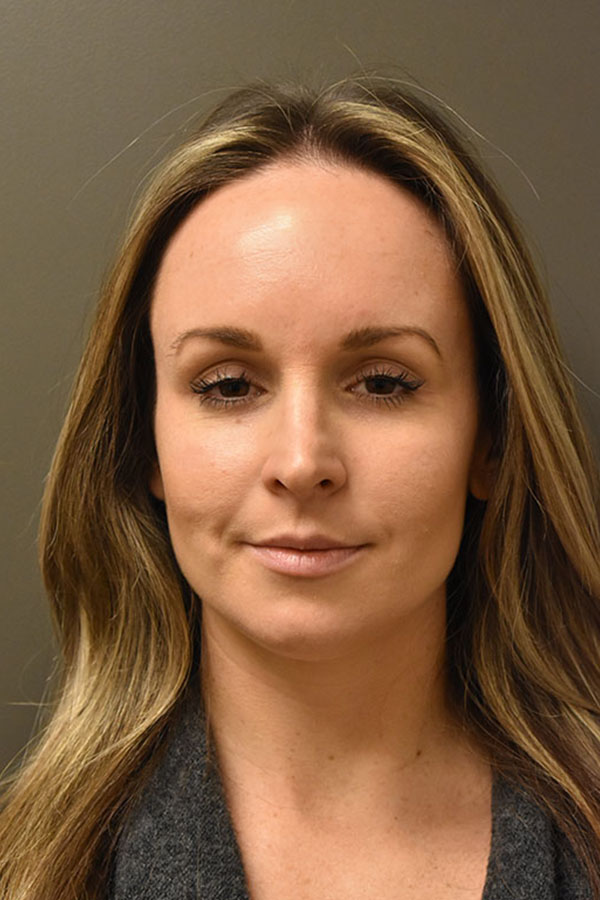 Non Surgical Browlift  Before and After | Northside Plastic Surgery