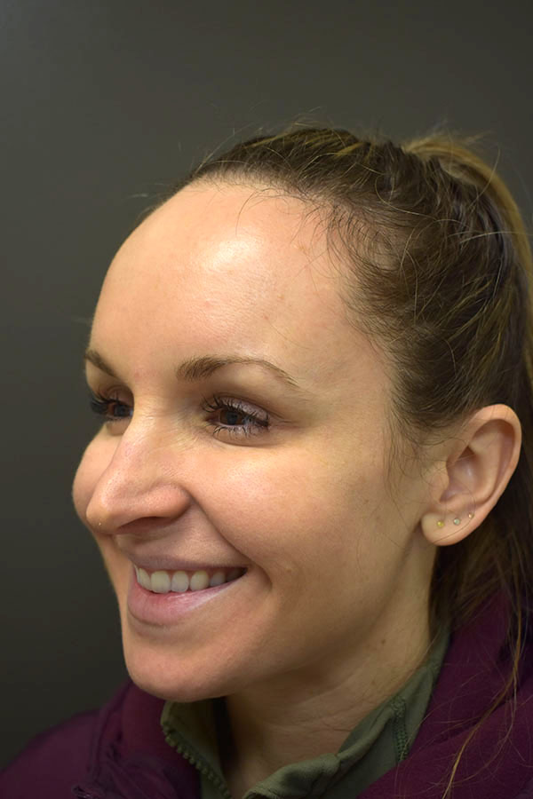 Non Surgical Browlift  Before and After | Northside Plastic Surgery