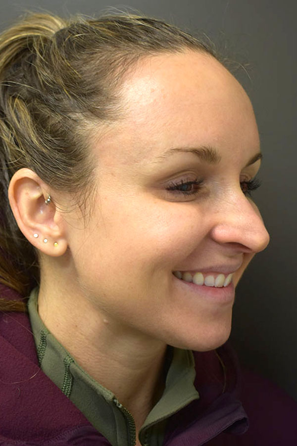 Non Surgical Browlift  Before and After | Northside Plastic Surgery