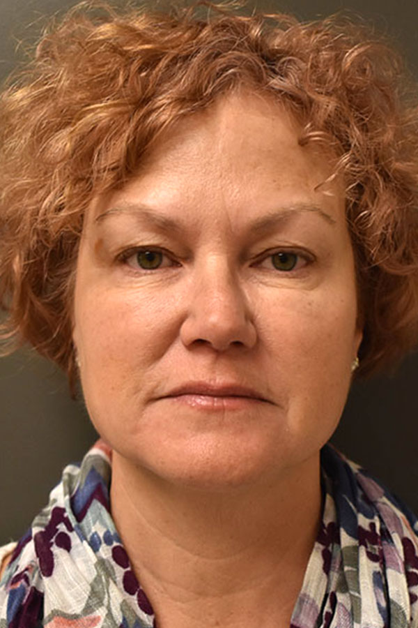 Non Surgical Browlift  Before and After | Northside Plastic Surgery