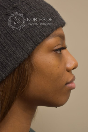 Non Surgical Chin Augmentation Before and After | Northside Plastic Surgery