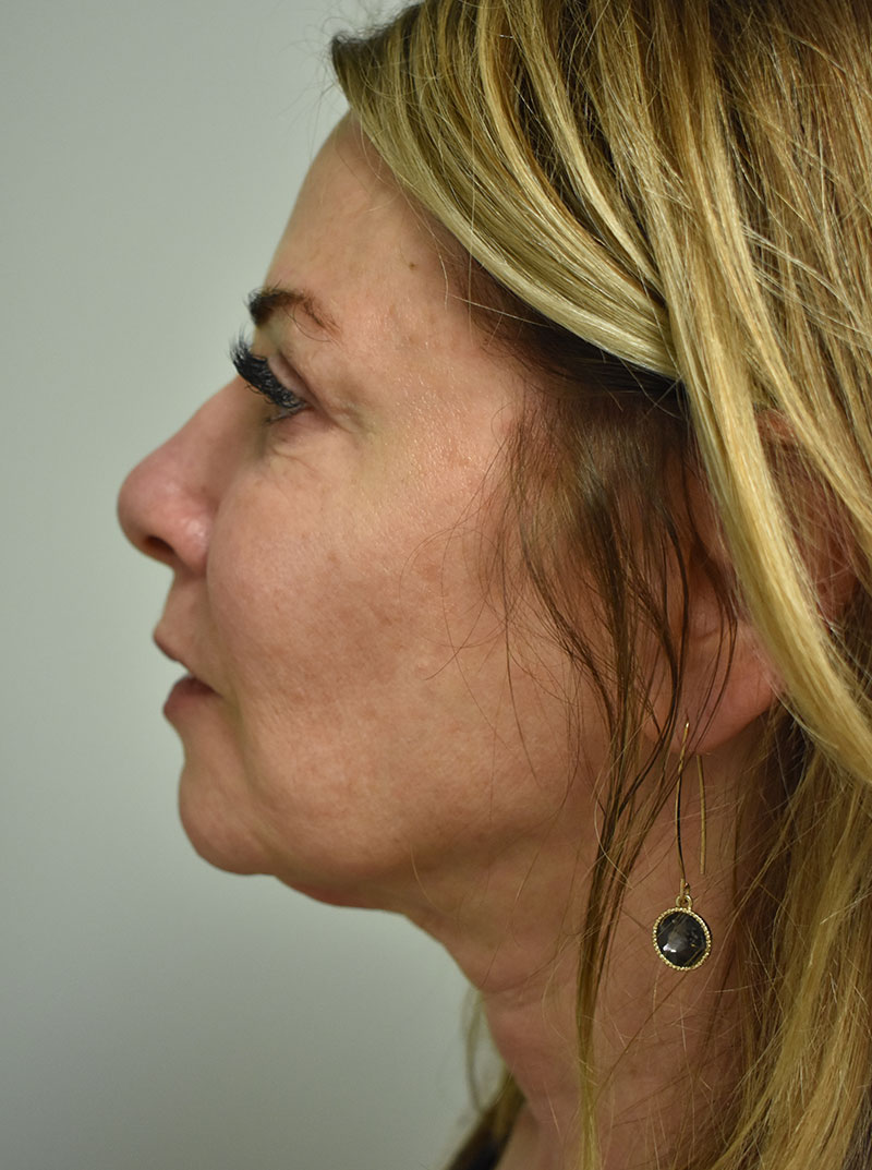 Non Surgical Jawline Lift Before and After | Northside Plastic Surgery
