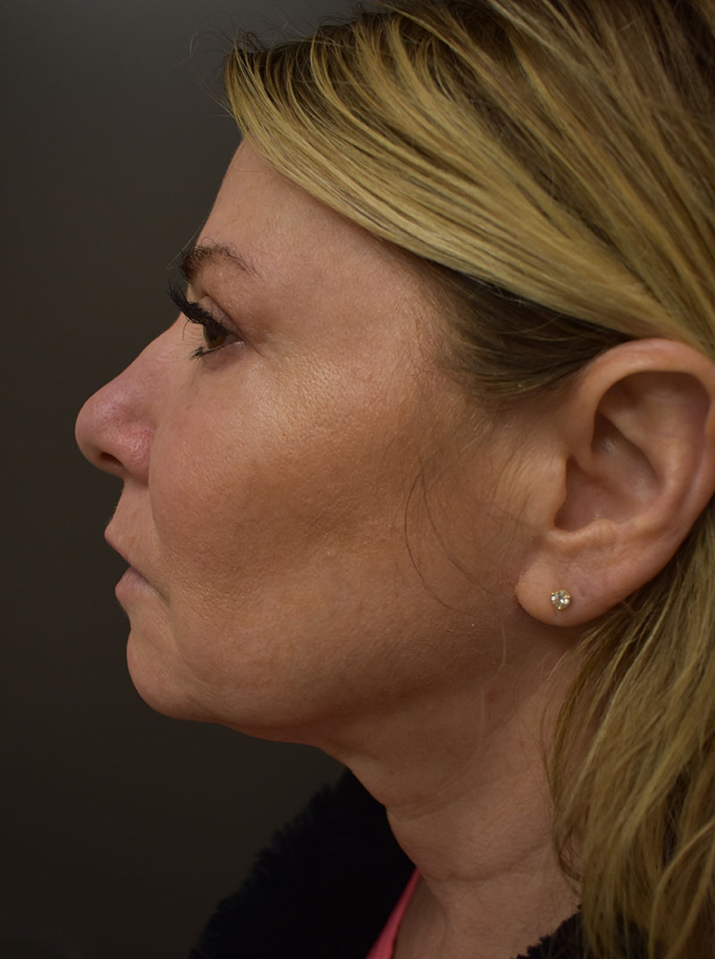 Non Surgical Jawline Lift Before and After | Northside Plastic Surgery