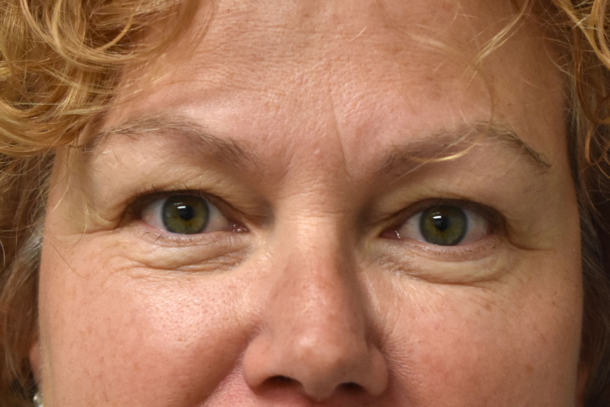 Non Surgical Lower Eyelid Rejuvenation Before and After | Northside Plastic Surgery