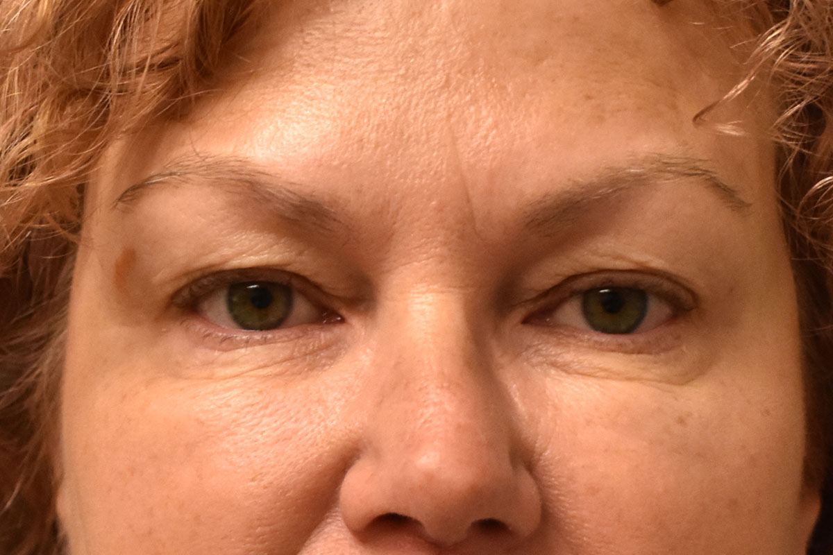 Non Surgical Lower Eyelid Rejuvenation Before and After | Northside Plastic Surgery