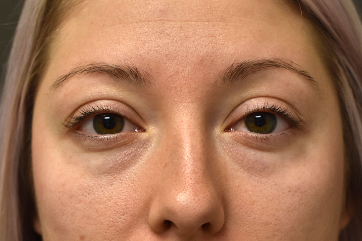 Non Surgical Lower Eyelid Rejuvenation Before and After | Northside Plastic Surgery