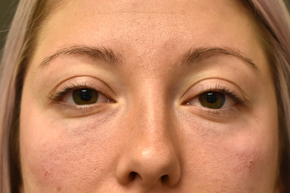 Non Surgical Lower Eyelid Rejuvenation Before and After | Northside Plastic Surgery