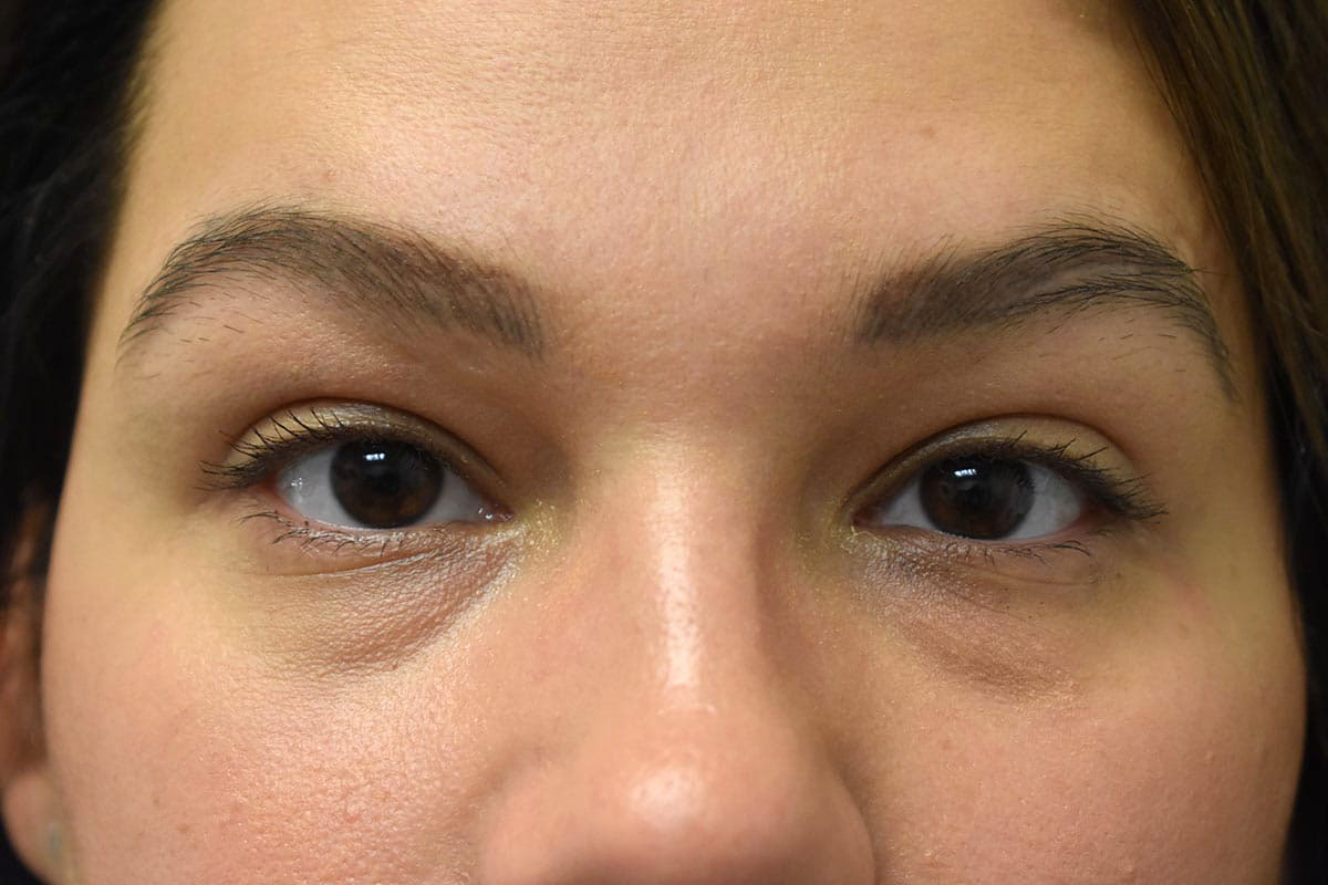 Non Surgical Lower Eyelid Rejuvenation Before and After | Northside Plastic Surgery