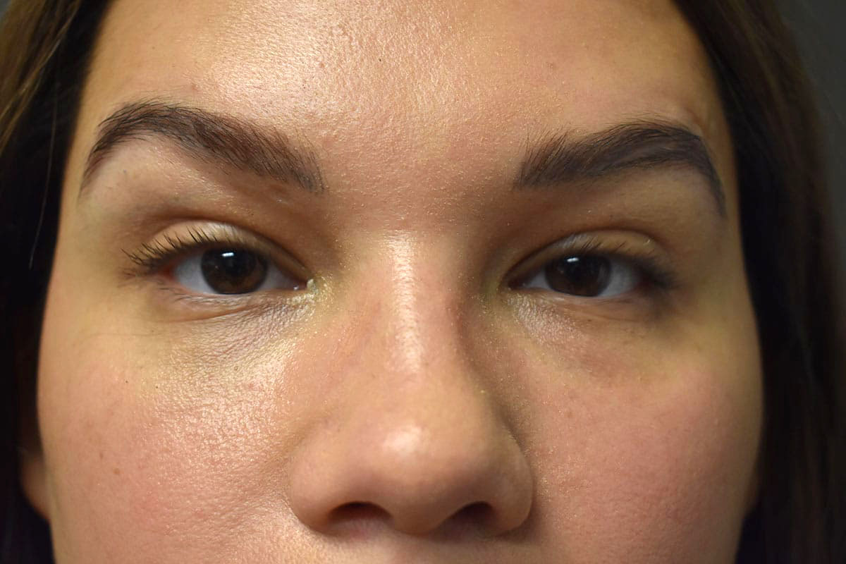 Non Surgical Lower Eyelid Rejuvenation Before and After | Northside Plastic Surgery