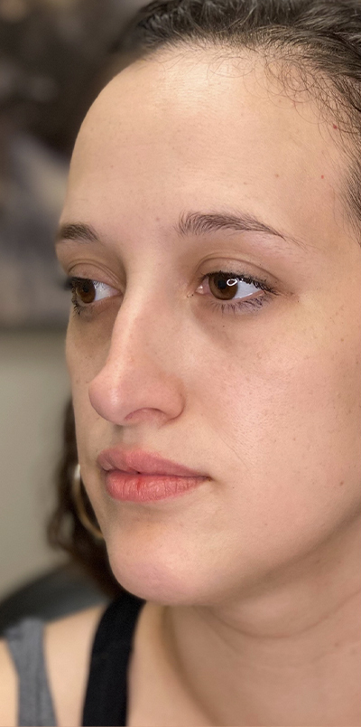 Non Surgical Rhinoplasty Before and After | Northside Plastic Surgery
