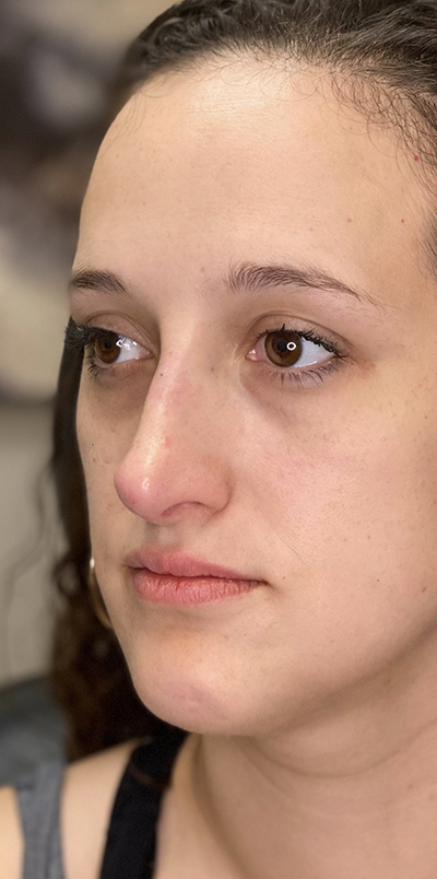 Non Surgical Rhinoplasty Before and After | Northside Plastic Surgery