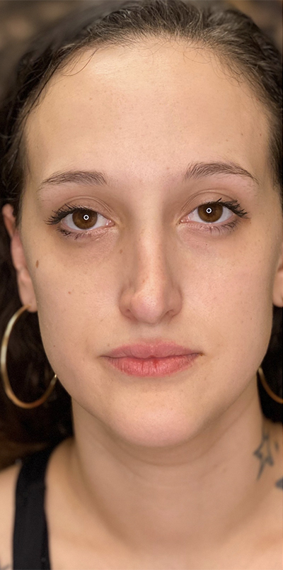 Non Surgical Rhinoplasty Before and After | Northside Plastic Surgery